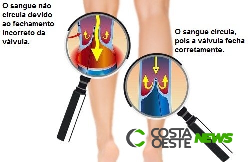 Como melhorar a circulação nos braços e nas pernas?