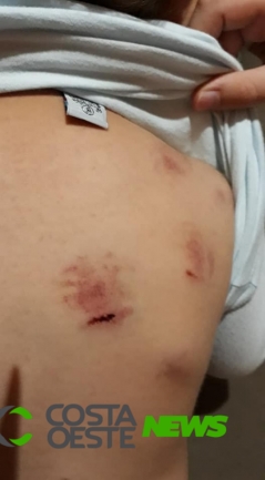 Mãe diz que filho levou 10 mordidas em creche no Paraná