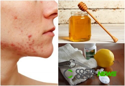 6 remédios naturais para enfrentar a acne cística