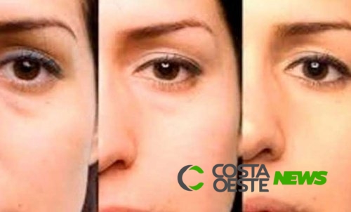 Dicas para se livrar das bolsas nos olhos