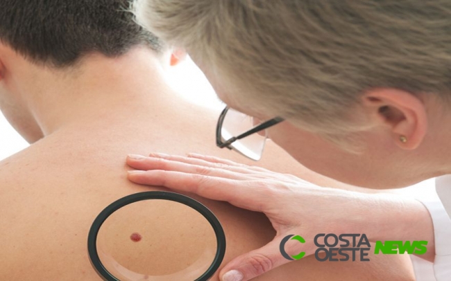 Brasil tem 180 mil novos casos de câncer de pele por ano