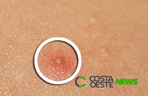 Tratamento com chá verde para tratar a acne