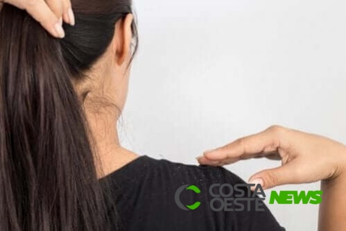 Tratamento com ovo para caspa no cabelo